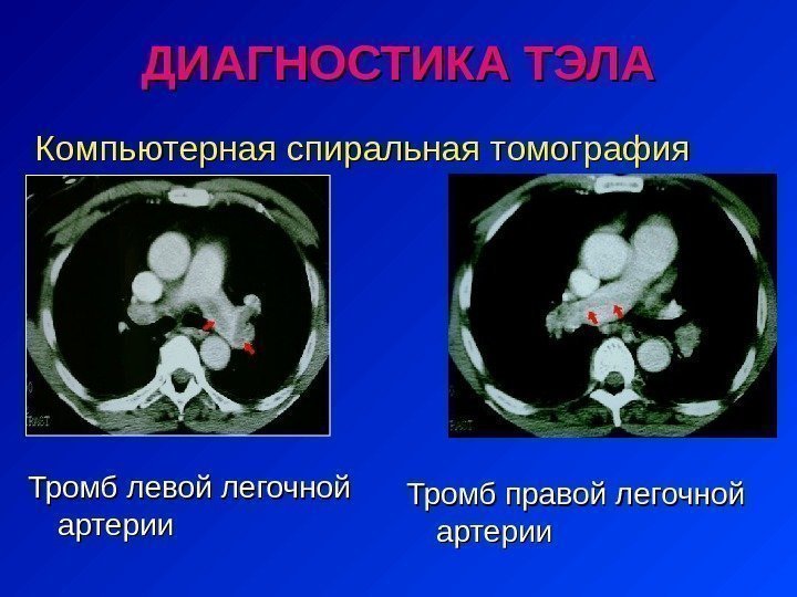 Компьютерная спиральная томография  Тромб левой легочной артерии Тромб правой легочной артерии. ДИАГНОСТИКА ТЭЛА