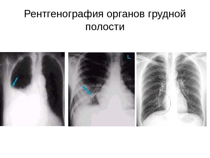 Рентгенография органов грудной полости 