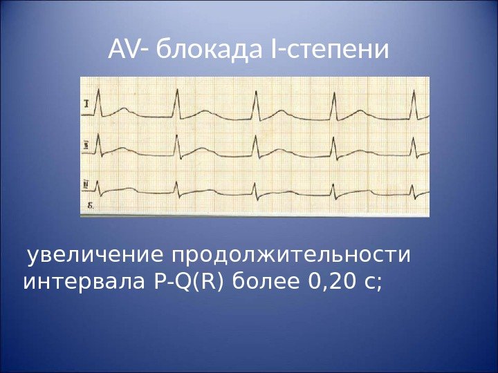 AV- блокада I- степени  увеличение продолжительности интервала P - Q ( R )