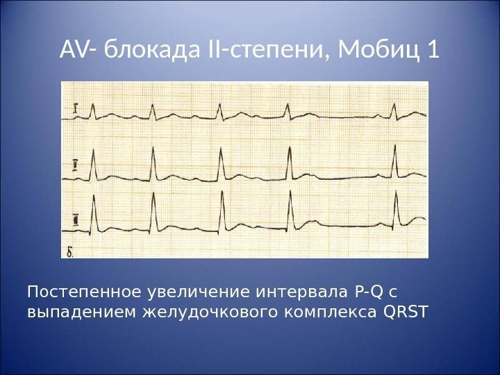 AV- блокада II- степени, Мобиц 1 Постепенное увеличение интервала P-Q c выпадением желудочкового комплекса