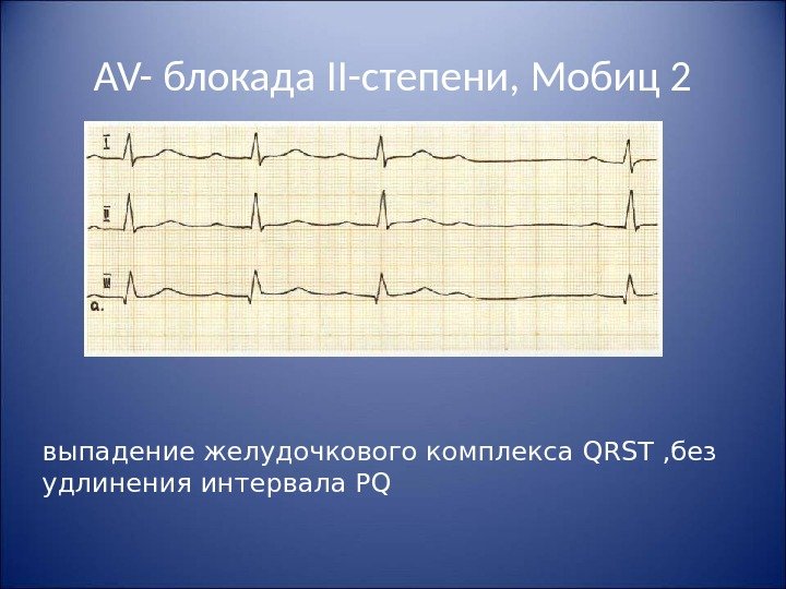 AV- блокада II- степени, Мобиц 2 выпадение желудочкового комплекса QRST , без удлинения интервала