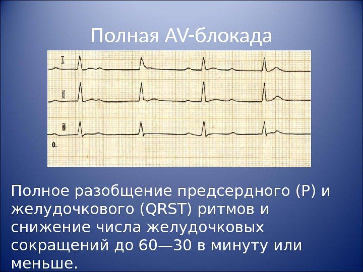 Полная AV- блокада Полное разобщение предсердного (Р) и желудочкового ( QRST ) ритмов и