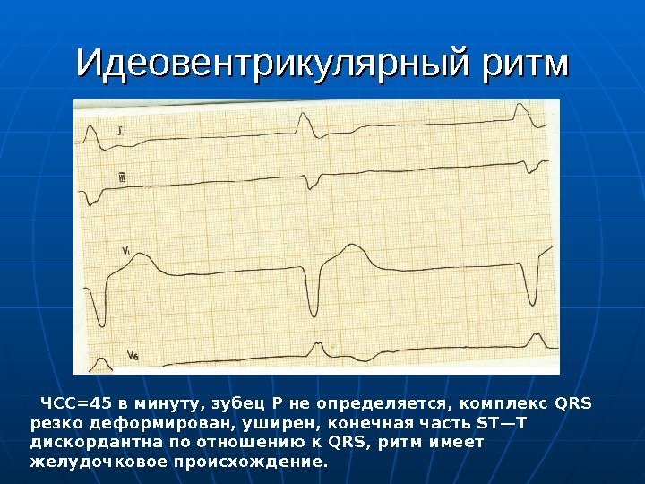 Идеовентрикулярный ритм  ЧСС=45 в минуту, зубец Р не определяется, комплекс QRS резко деформирован,