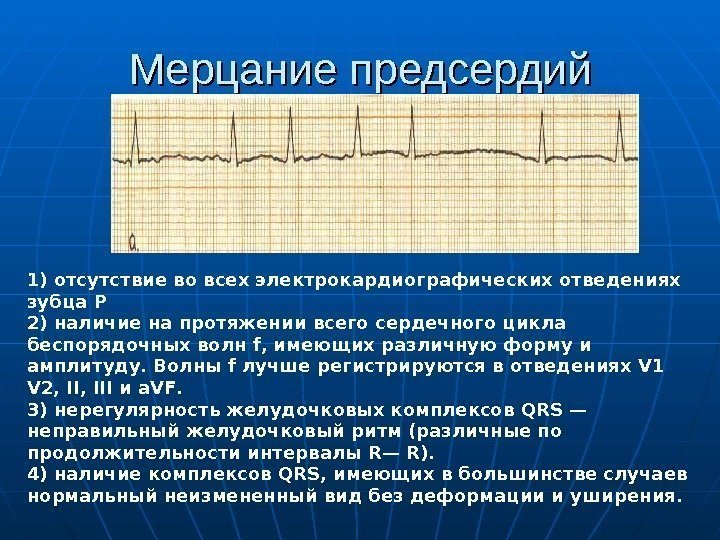 Мерцание предсердий 1) отсутствие во всех электрокардиографических отведениях зубца P 2) наличие на протяжении