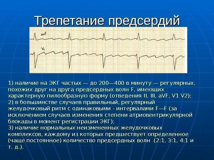 Трепетание предсердий 1) наличие на ЭКГ частых — до 200— 400 в минуту —