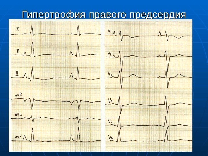 Гипертрофия правого предсердия 