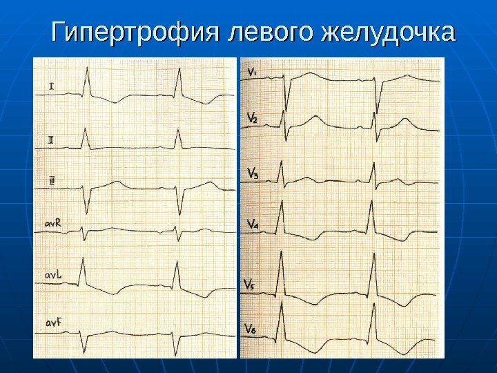 Гипертрофия левого желудочка 