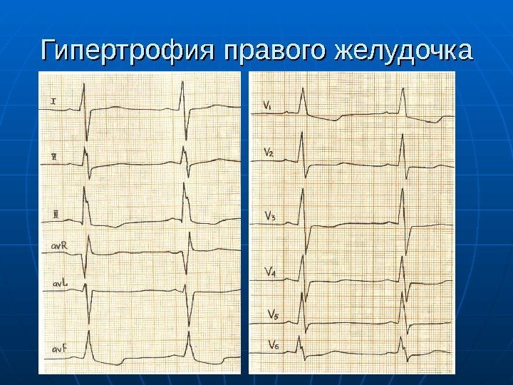 Гипертрофия правого желудочка 