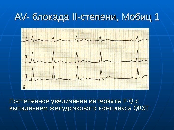 AV- блокада II- степени, Мобиц 1 Постепенное увеличение интервала P-Q c выпадением желудочкового комплекса