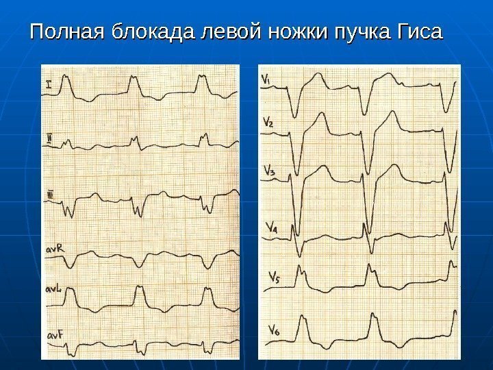 Полная блокада левой ножки пучка Гиса 