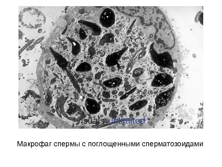 Макрофаг спермы с поглощенными сперматозоидами 
