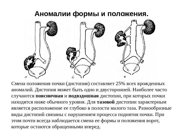 Аномалии формы и положения.  Смена положения почки (дистопия) составляет 25 всех врожденных аномалий.