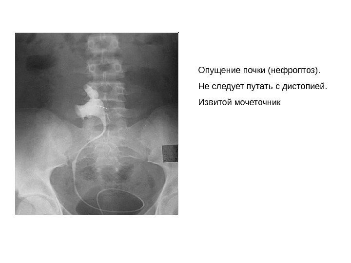 Опущение почки (нефроптоз). Не следует путать с дистопией. Извитой мочеточник 