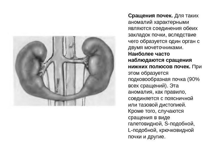 Сращения почек.  Для таких аномалий характерными являются соединения обеих закладок почки, вследствие чего