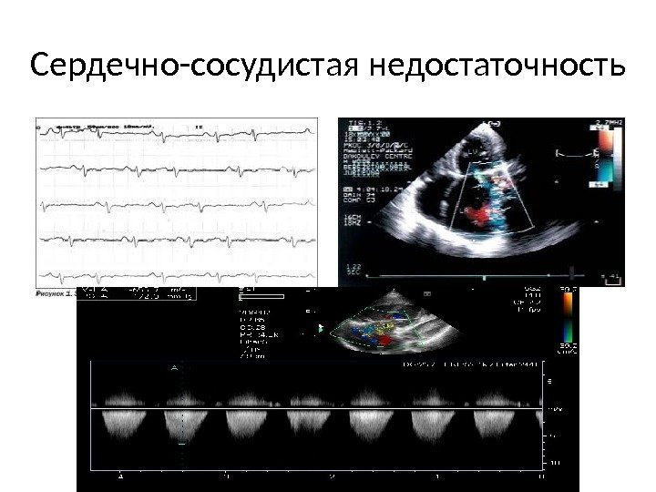 Сердечно-сосудистая недостаточность 