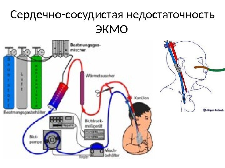 Сердечно-сосудистая недостаточность ЭКМО  