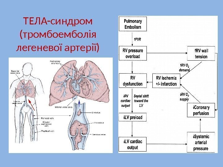 ТЕЛА-синдром (тромбоемболія легеневої артерії) 
