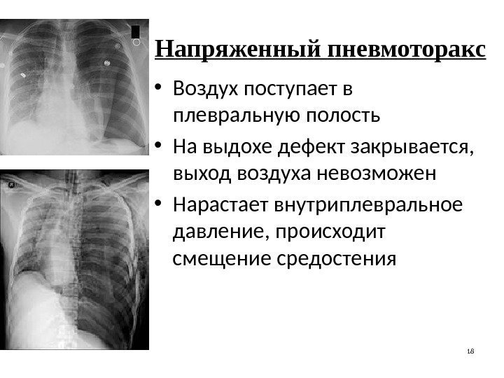 Напряженный пневмоторакс • Воздух поступает в плевральную полость • На выдохе дефект закрывается, 