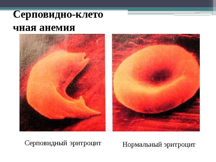Серповидно-клето чная анемия Серповидный  эритроцит Нормальный эритроцит     