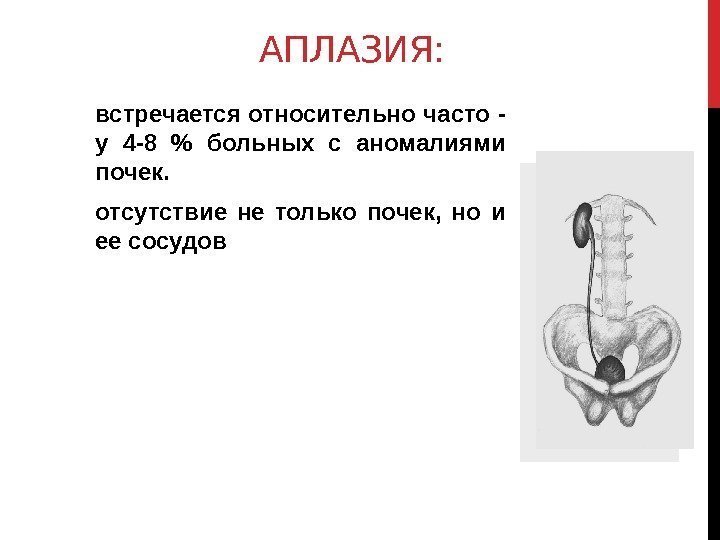 АПЛАЗИЯ: встречается относительно часто - у 4 -8  больных с аномалиями почек. отсутствие