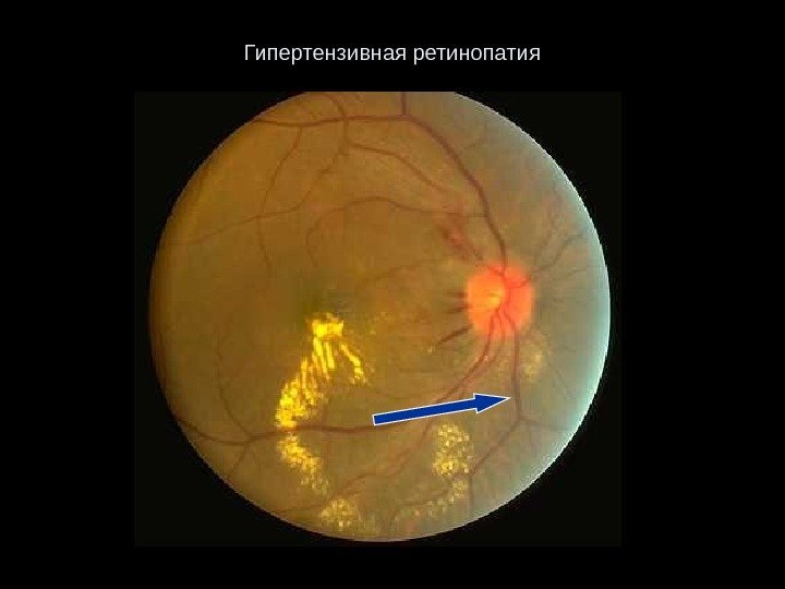 Гипертензивная ретинопатия 