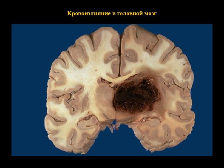 Кровоизлияние в головной мозг 