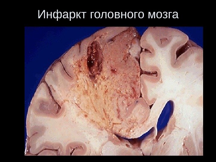 Инфаркт головного мозга 