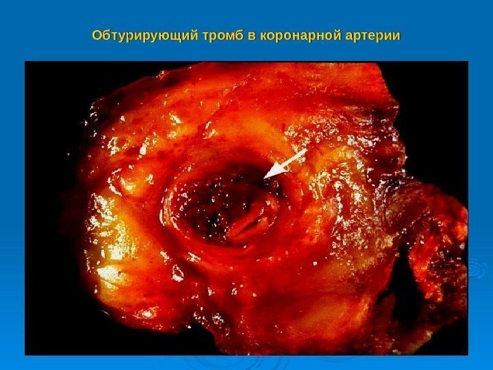Обтурирующий тромб в коронарной артерии 