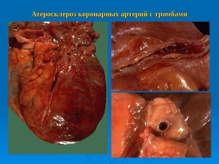 Атеросклероз коронарных артерий с тромбами 