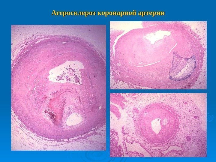 Атеросклероз коронарной артерии 