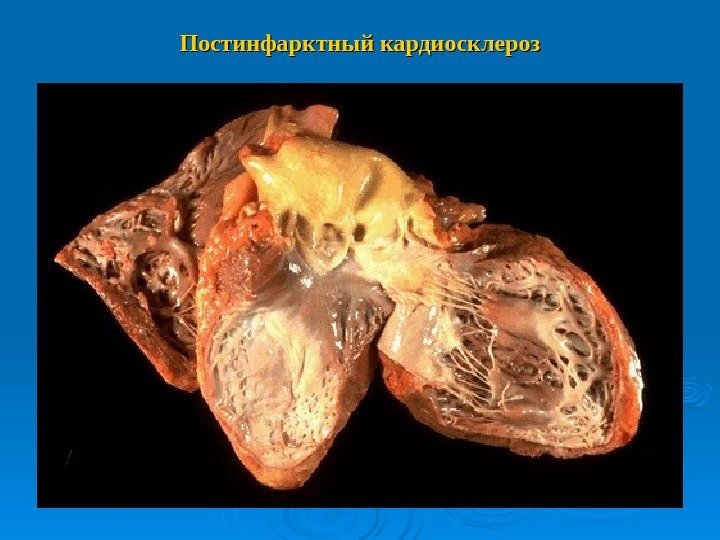 Постинфарктный кардиосклероз 