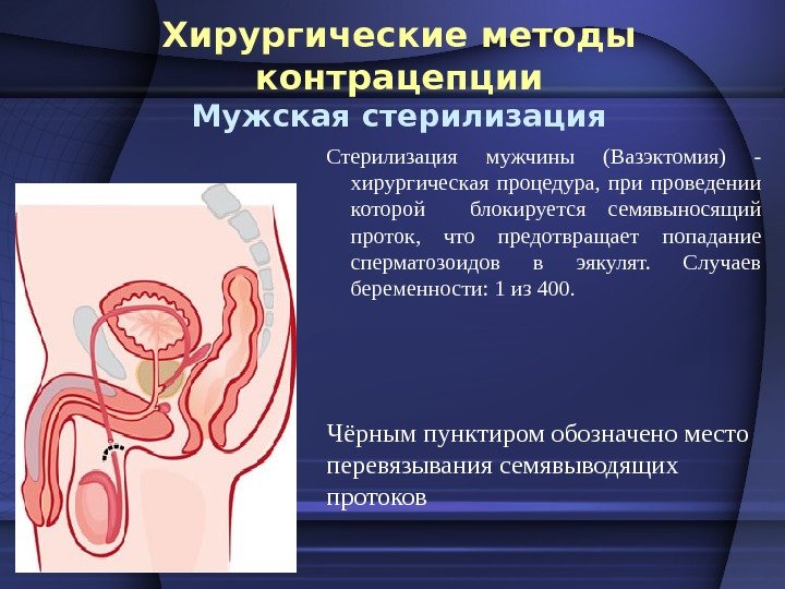 Хирургические методы контрацепции Мужская стерилизация Стерилизация мужчины (Вазэктомия) - хирургическая процедура,  при проведении