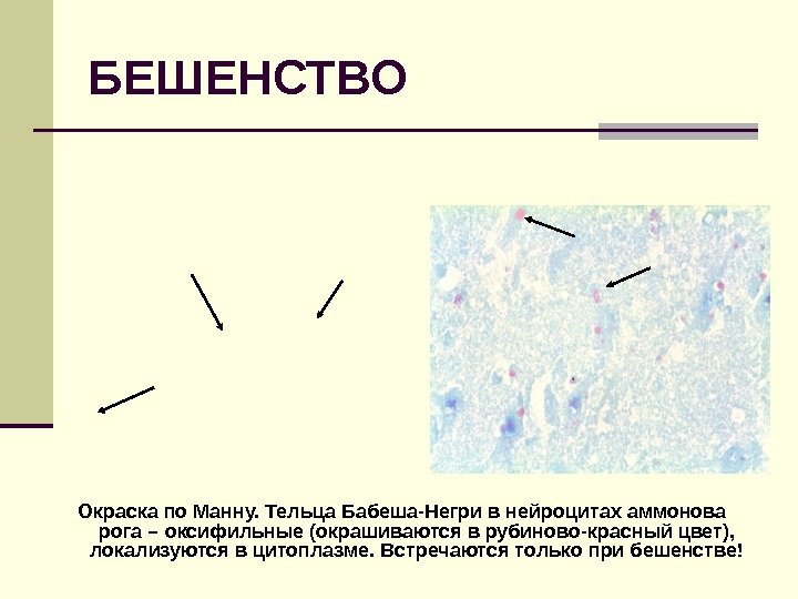 БЕШЕНСТВО Окраска по Манну. Тельца Бабеша-Негри в нейроцитах аммонова рога – оксифильные (окрашиваются в