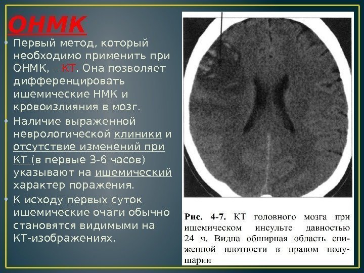 ОНМК • Первый метод, который необходимо применить при ОНМК, – КТ. Она позволяет дифференцировать