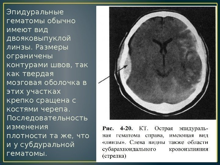 Эпидуральные гематомы обычно имеют вид двояковыпуклой линзы. Размеры ограничены контурами швов, так как твердая