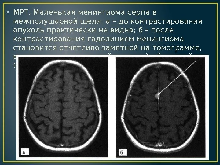  • МРТ. Маленькая менингиома серпа в межполушарной щели: а – до контрастирования опухоль