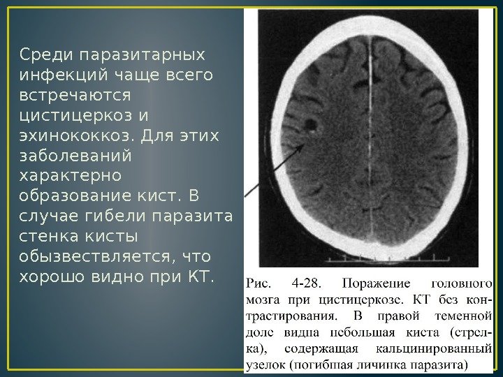 Среди паразитарных инфекций чаще всего встречаются цистицеркоз и эхинококкоз. Для этих заболеваний характерно образование