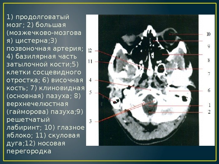 1) продолговатый мозг; 2) большая (мозжечково-мозгова я) цистерна; 3) позвоночная артерия;  4) базилярная