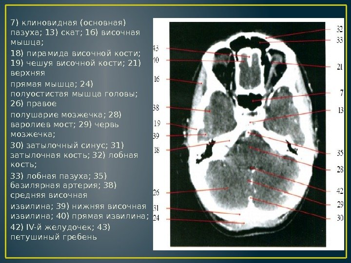 7) клиновидная (основная) пазуха; 13) скат; 16) височная мышца; 18) пирамида височной кости; 