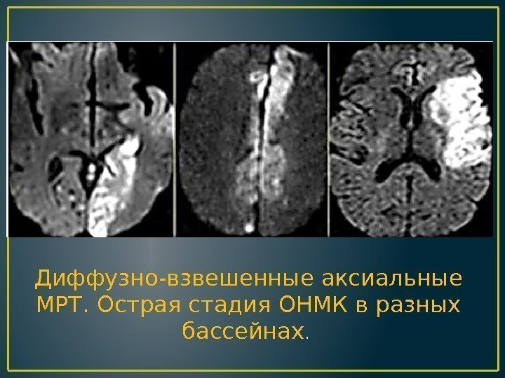 Диффузно-взвешенные аксиальные МРТ. Острая стадия ОНМК в разных бассейнах.  