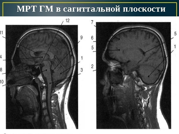 МРТ ГМ в сагиттальной плоскости 