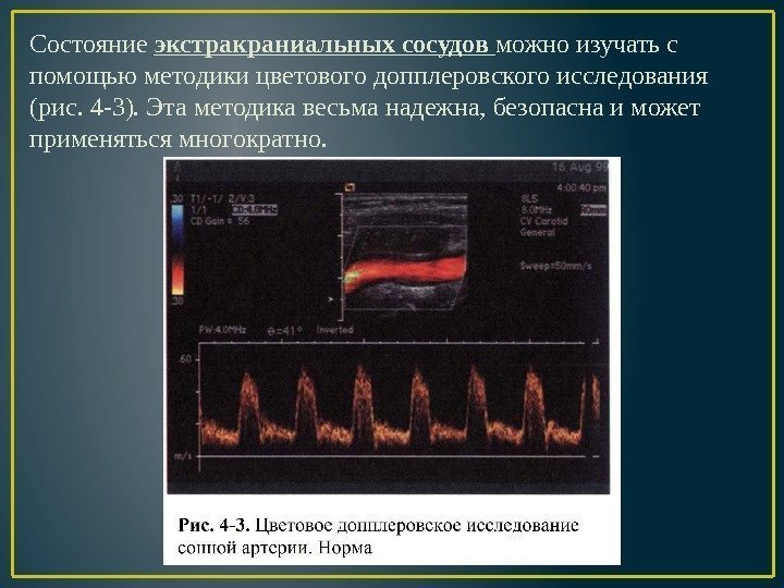 Состояние экстракраниальных сосудов можно изучать с помощью методики цветового допплеровского исследования (рис. 4 -3).