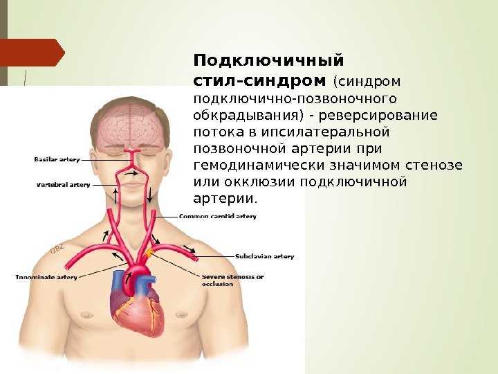 Подключичный стил-синдром (синдром подключично-позвоночного обкрадывания) - реверсирование потока в ипсилатеральной позвоночной артерии при гемодинамически