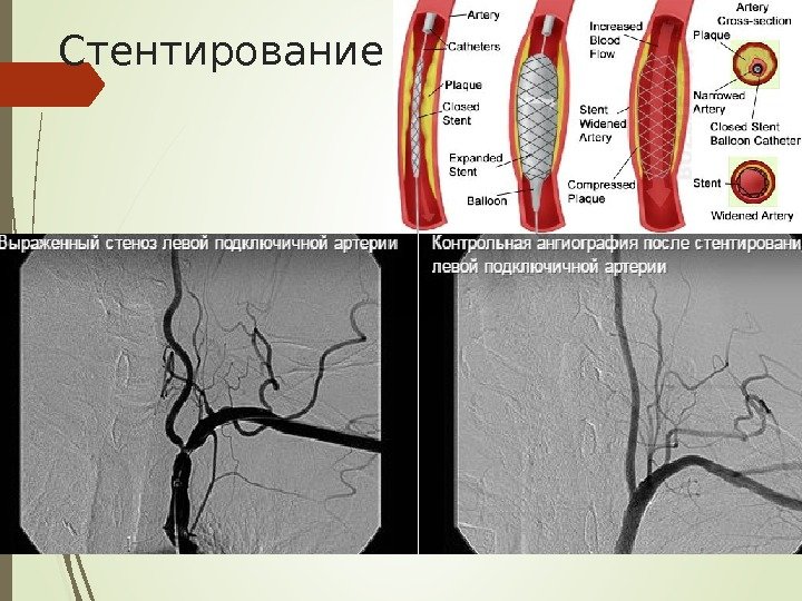 Стентирование   