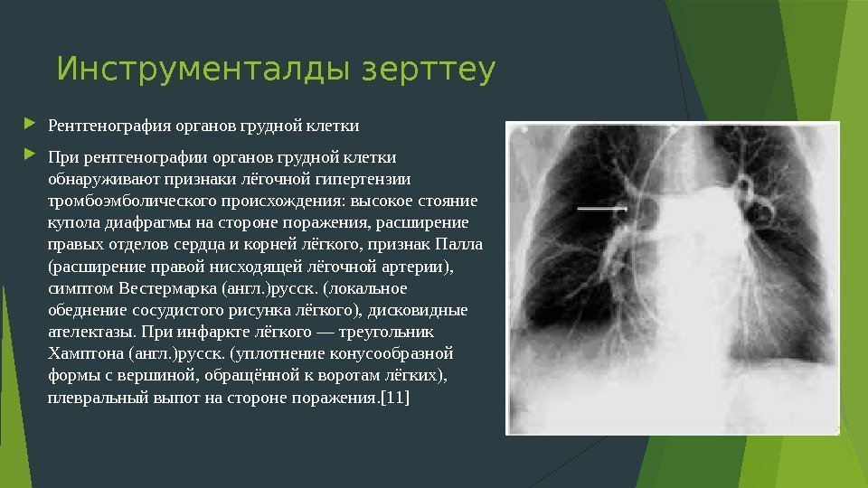 Инструменталды зерттеу Рентгенография органов грудной клетки При рентгенографии органов грудной клетки обнаруживают признаки лёгочной