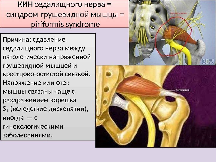 КИН седалищного нерва = синдром грушевидной мышцы = piriformis syndrome Причина: сдавление седалищного нерва