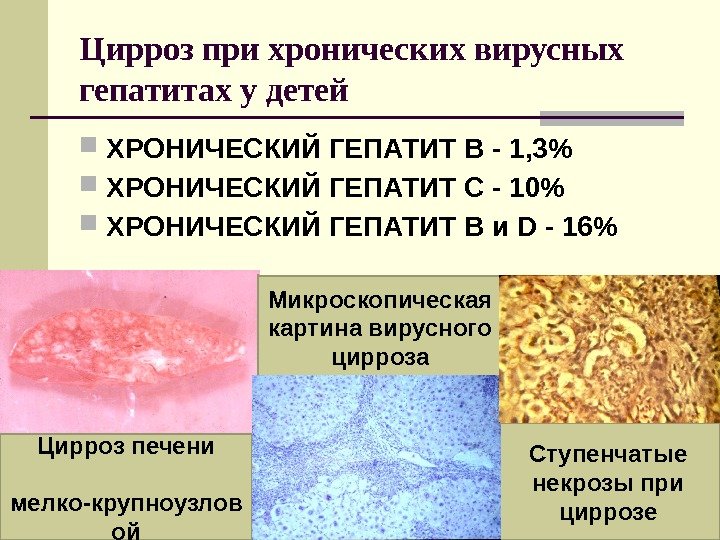 Цирроз при хронических вирусных гепатитах у детей  ХРОНИЧЕСКИЙ ГЕПАТИТ В - 1, 3