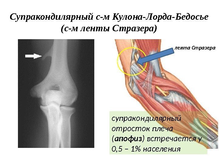 Супракондилярный с-м Кулона-Лорда-Бедосье (с-м ленты Стразера) супракондилярный отросток плеча ( апофиз ) встречается у