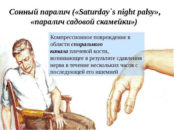 Сонный паралич ( «Saturday`s night palsy» ,  «паралич садовой скамейки» ) Компрессионное повреждение