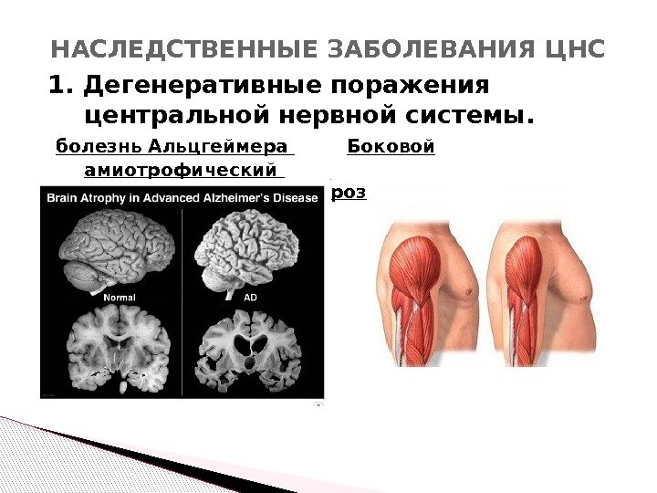 1. Дегенеративные поражения центральной нервной системы. болезнь Альцгеймера Боковой амиотрофический склероз. НАСЛЕДСТВЕННЫЕ ЗАБОЛЕВАНИЯ ЦНС